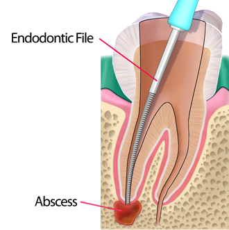 Removing Pulp